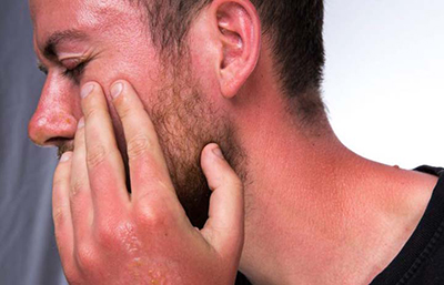 رفع آفتاب سوختگی صورت،راه های جلوگیری از آفتاب سوختگی درمان آفتاب سوختگی
