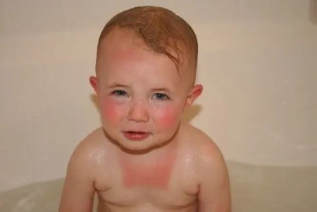 درمان آفتاب سوختگی صورت کودکان