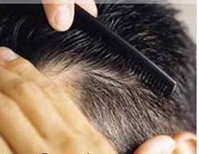درمان ریزش مو,درمان قطعی ریزش مو,راههای درمان ریزش مو