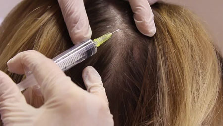 مزوتراپی مو, مزوتراپی مو چیست, بعد از مزوتراپی مو چه باید کرد