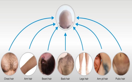 کاشت مو طبیعی از ناحیه تناسلی, مراحل کاشت مو از ناحیه تناسلی, مراقبت های بعد از کاشت مو