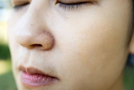علت پوسته پوسته شدن بینی