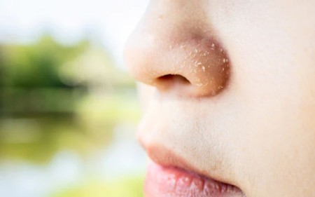 درمان های خانگی برای پوسته پوسته شدن بینی