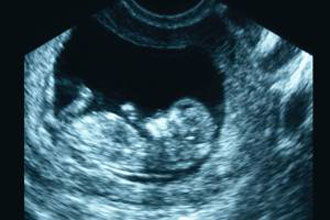 دلایل انجام سونوگرافی در 3 ماه اول و سوم بارداری