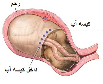 میزان آب دور جنین,درمان کم بودن آب دور جنین,زیاد شدن آب دور جنین,راههای کاهش آب دور جنین,علت کم شدن مایع دور جنین