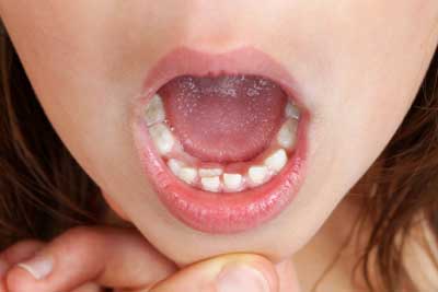 دندانهای دائمی کودکان
