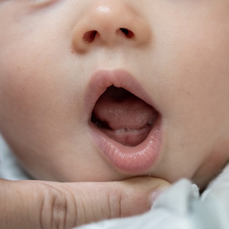 علت آفت دهان در کودکان, آفت دهان و لب کودکان, آفت دهان نوزادان