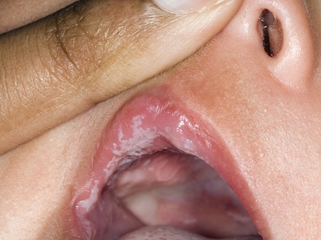 آفت دهان و لب کودکان, آفت دهان نوزادان, آفت دهان کودکان همراه با تب