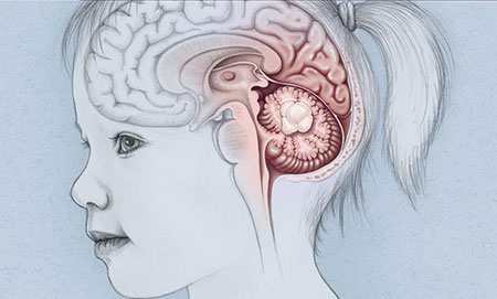 تومور مغزی در کودکان,دلایل تومور مغزی در کودکان,علائم تومور مغزی در کودکان