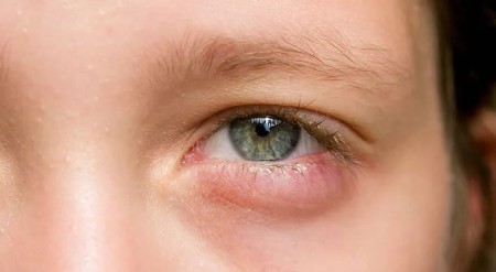 کاهش تورم چشم کودکان