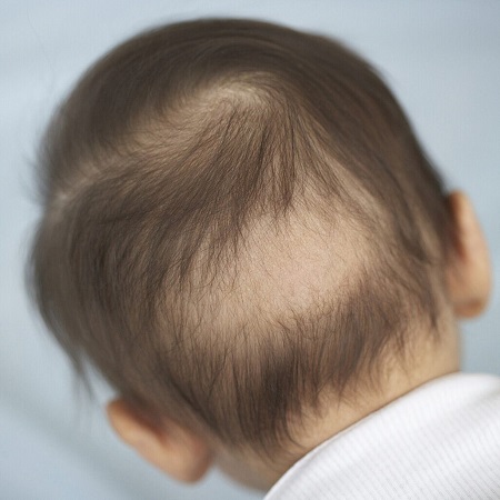 روش های پرپشت شدن مو,درمان کم پشتی موی کودکان,ریزش موی سکه ای