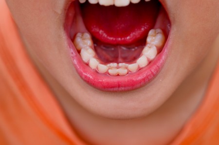 افتادن دندان‌ شیری کودکان, علت دیر افتادن دندان‌ شیری کودکان,بررسی علل دیر افتادن دندان شیری