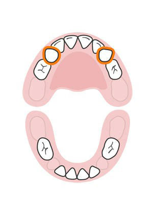 دندان های شیری کودک,دندان های پیشین فک بالا