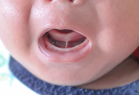 درمان چسبیدن زبان به کف دهان, علایم چسبیدن زبان به کف دهان, چسبندگی زبان در کودکان
