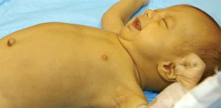 زردی نوزادان,شیوع زردی نوزادان,روش درمان زردی نوزادان