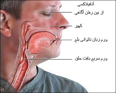علل و علائم بیماری آنافیلاکسی‌ (شوک‌ آلرژیک‌)