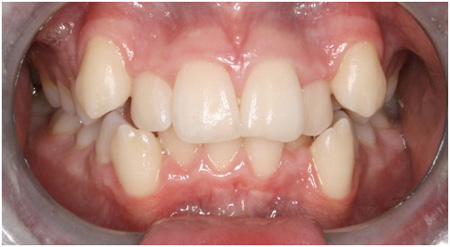 زیبایی دندان بدون ارتودنسی
