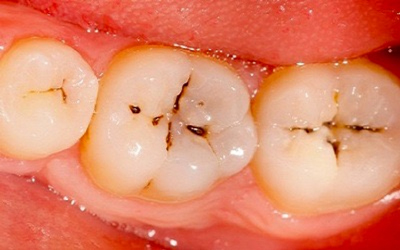 عفونت دندان روکش شده, نشانهای عفونت دندان