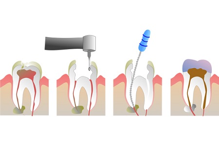 مراقبت بعد از پالپکتومی دندان, کاربرد پالپکتومی دندان, پالپکتومی دندان