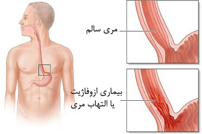 علایم سرطان مری, درمان سرطان مری