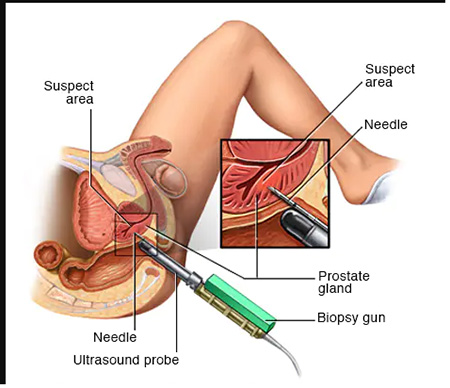 راه های پیشگیری از سرطان پروستات همه چیز درمورد سرطان پروستات,علائم سرطان پروستات,دلایل سرطان پروستات