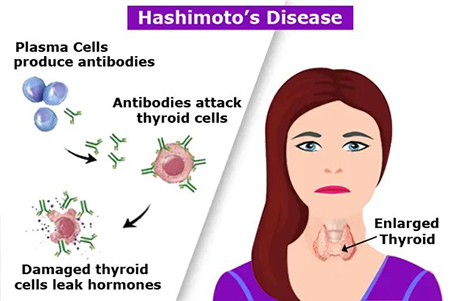 رژیم غذایی بیماری هاشیموتو, برنامه رژیم غذایی بیماری هاشیموتو, مواد غذایی مناسب برای بیماری هاشیموتو