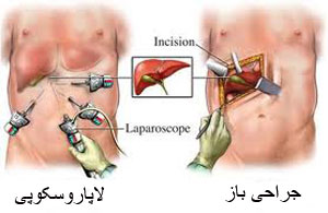 لاپاروسکوپی, جراحی باز, عمل جراحی
