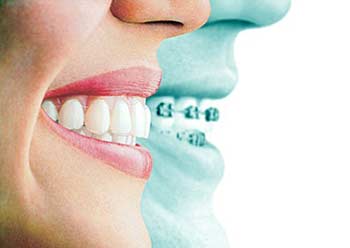 دندانپزشکی, نگهدارنده ارتودنسی, اورتودنسی