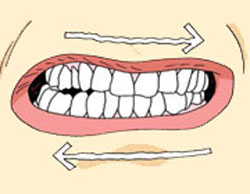 دندان قروچه, علل دندان قروچه