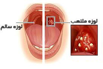 انواع التهاب لوزه, غدد لنفاوی گردن