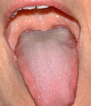 زخم زبان سرطان می آورد ! 1