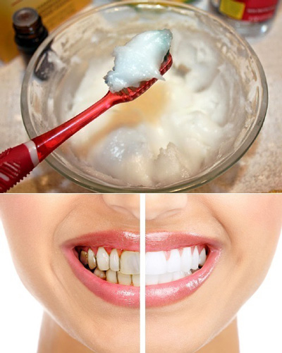 سفید کننده دندان خانگی