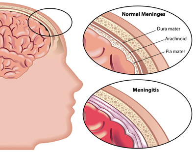 نشانه های بیماری مننژیت  , مننژیت