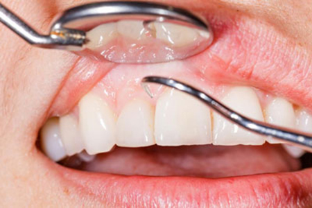 بیماری هایی که از طریق دندان‌ها مشخص می‌شوند!