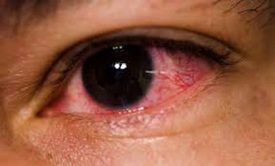 کاهش قرمزی چشم,علایم قرمزی چشم