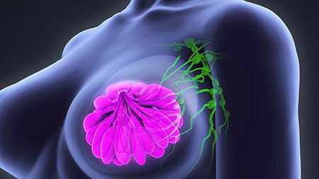 نشانه های سرطان سینه