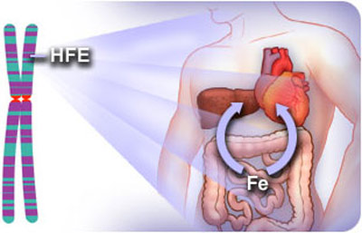 علائم هموکروماتوز در کودکان, هموکروماتوز چیست