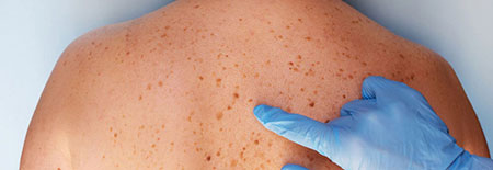 خال های پوستی,جلوگیری از سرطان پوست