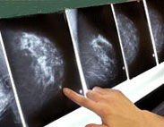 بیماریهای زنان,سرطان سینه,ماموگرافی سینه