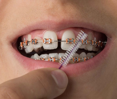 صاف شدن دندان بدون ارتودنسی, درمان کجی دندان با کامپوزیت, زیبایی دندان