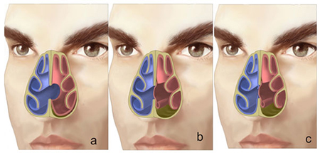 سوراخ شدن تیغه بینی, سوراخ شدن تیغه بینی بعد از عمل, سوراخ‌های کوچک ممکن است علامتی نداشته باشند