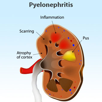 [عکس: pyelonephritis3-e9.jpg]