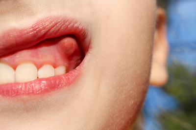 کیست دندانی چیست و چگونه درمان می شود