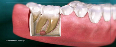 عوارض کیست دندان