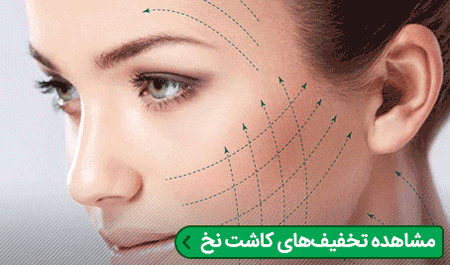 لاغری سریع,دستگاه های لاغری,کاشت نخ