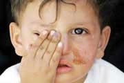 زخم های زردرنگ پوستی زخم های زردرنگ پوستی