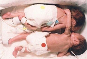 نوزادی که به شکل باورنکردنی خواهرش را نجات داد نوزادی که به شکل باورنکردنی خواهرش را نجات داد