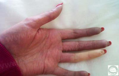 حمام,حمام در وان روغن,بیماریهای عجیب