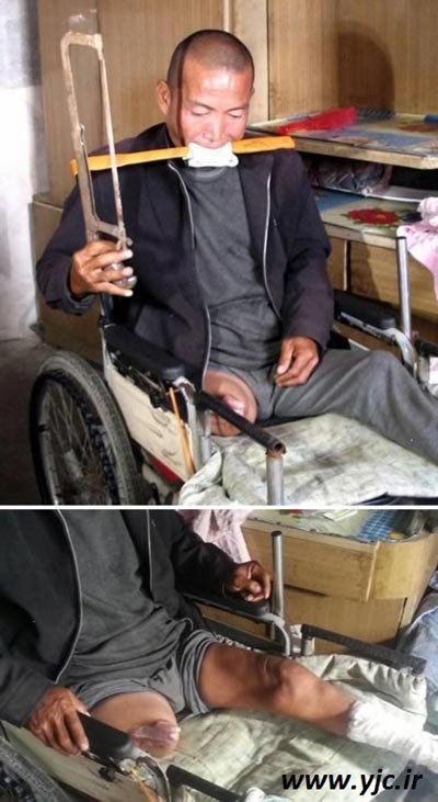 عمل جراحی,عمل جراحی توسط خود بیماران عمل جراحی,عمل جراحی توسط خود بیماران