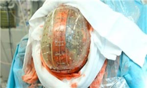 اولین کاشت سهبعدی جمجمه درجهان+تصاویر